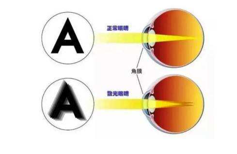 散光可以戴散光隐形眼镜吗？(图1)