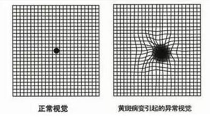 高度近视可以戴隐形眼镜吗？(图2)